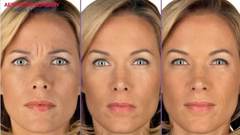 The effects of a smile lift botox last about 3–4 months.