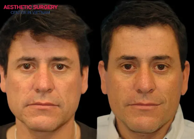 You need 7–10 days for the wound to heal, but it takes about 1 month to see the most natural results.