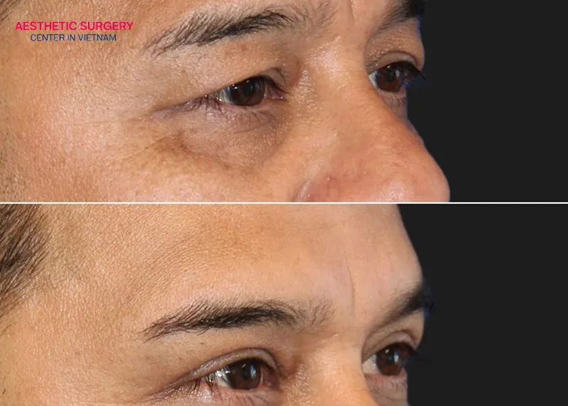 Brow lift surgery for men delivers natural-looking and masculine results.