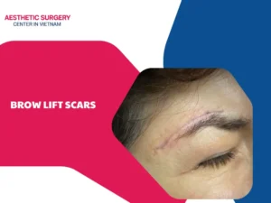 What do brow lift scars look like? Can they be treated?