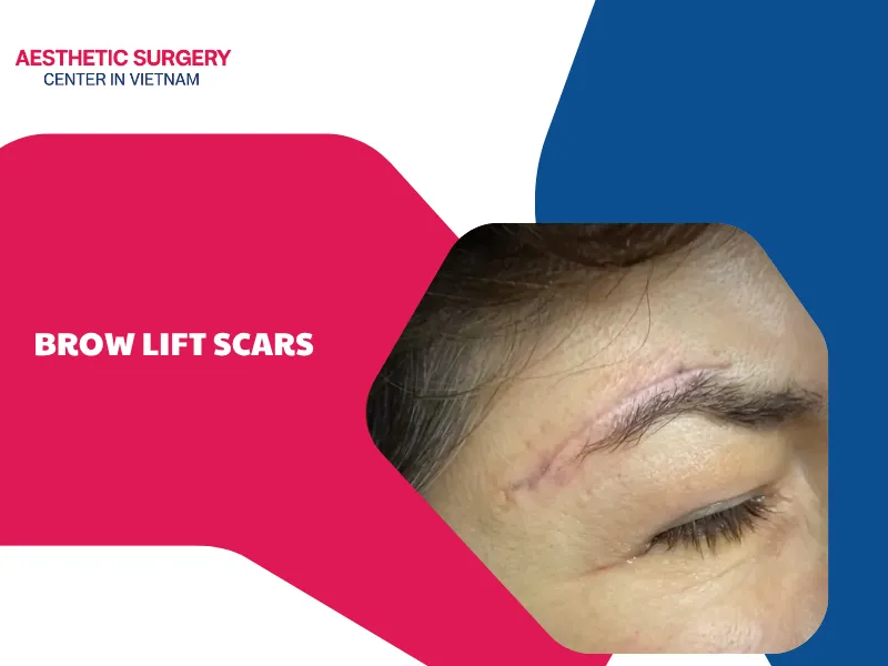 What do brow lift scars look like? Can they be treated?