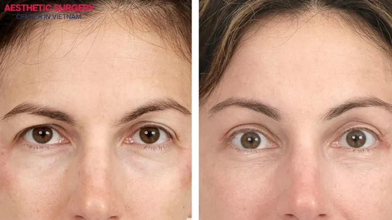 A brow lift with botox allows you to return to normal activities immediately after the injection.