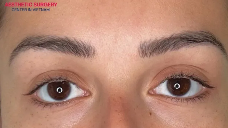 Keep an upright posture after a botox brow lift.