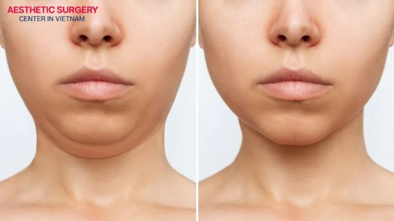There are many causes that can lead to chin filler shifting or migrating.