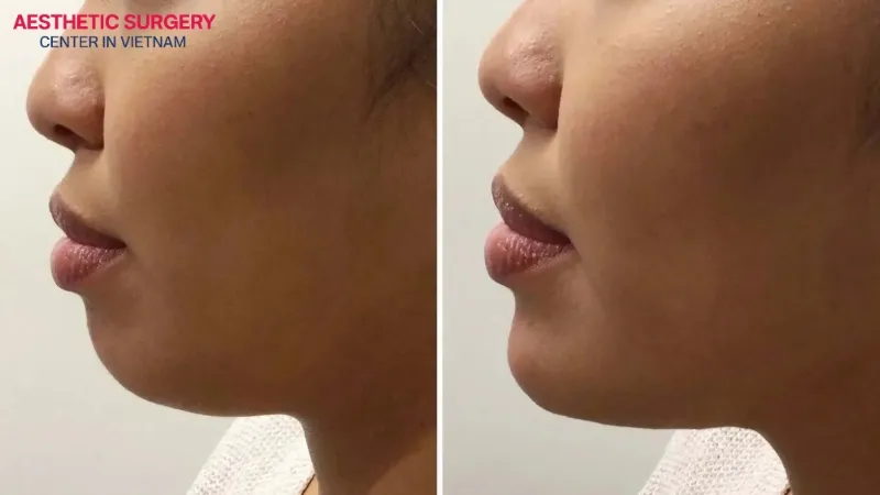 Chin filler migration can cause several noticeable signs.