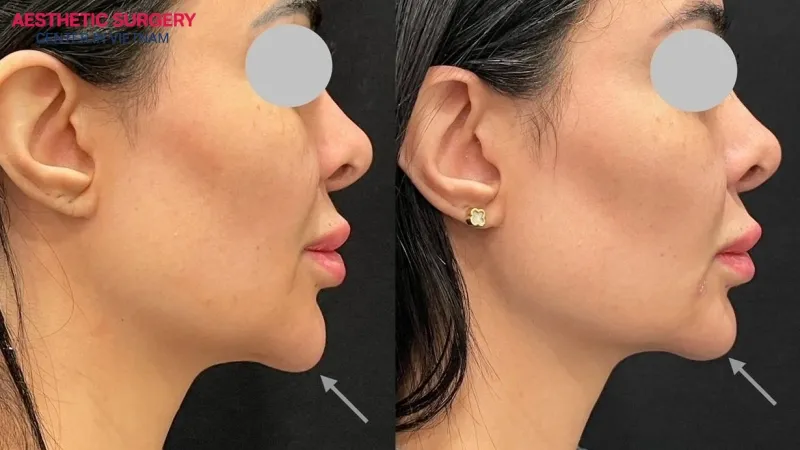 There are several ways to help prevent chin filler migration.