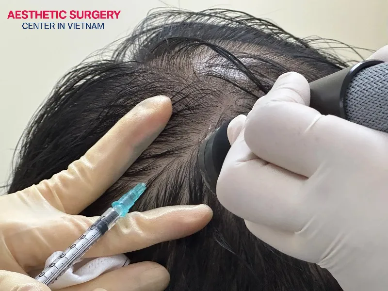 The injection of local anesthetic at the beginning of a hair transplant surgery can cause the most noticeable pain