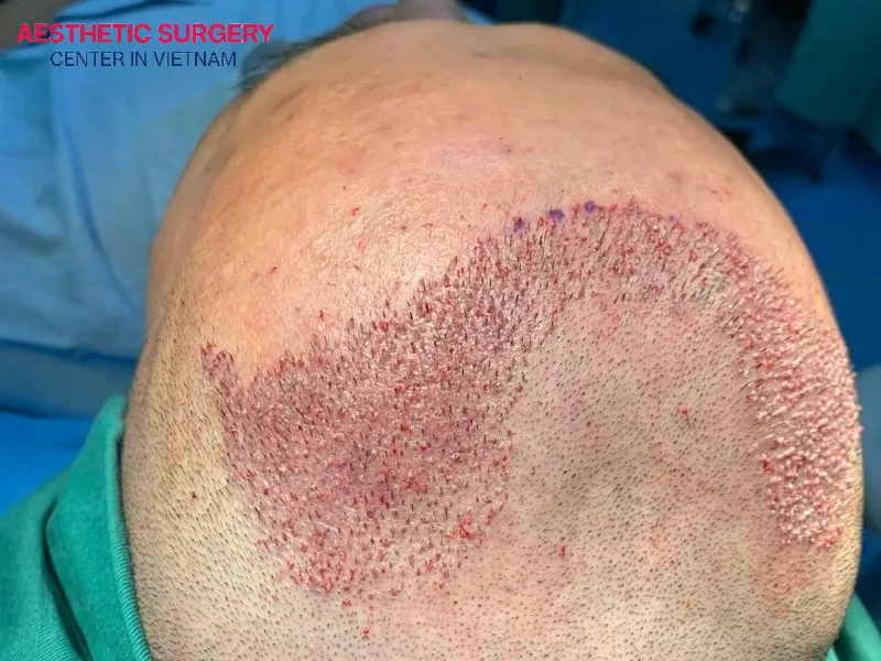 Inflammation and swelling following a hair transplant will cause a dull, aching pain for the first 2-3 days.