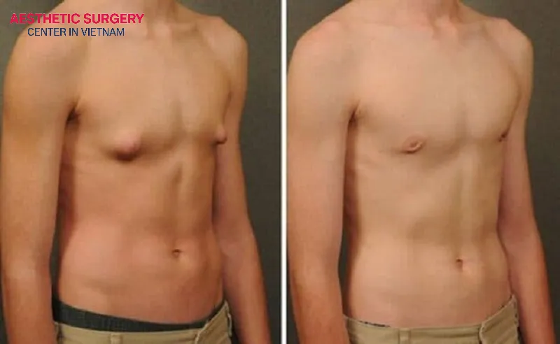Medical insurance provides coverage for breast reduction surgery as a treatment for mammary hypertrophy