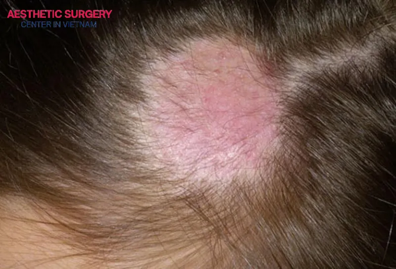 If a doctor uses hair transplantation to treat chronic inflammatory seborrheic dermatitis, insurance may cover this portion, but the likelihood is quite low.