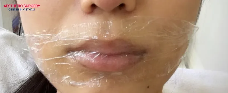 Numbing the lips is a crucial factor affecting the pain experienced during lip filler injections