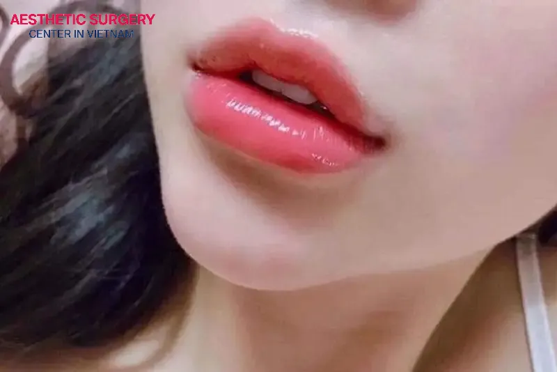 The feeling of tightness or tenderness in the lips will completely subside 5–7 days after filler injection.