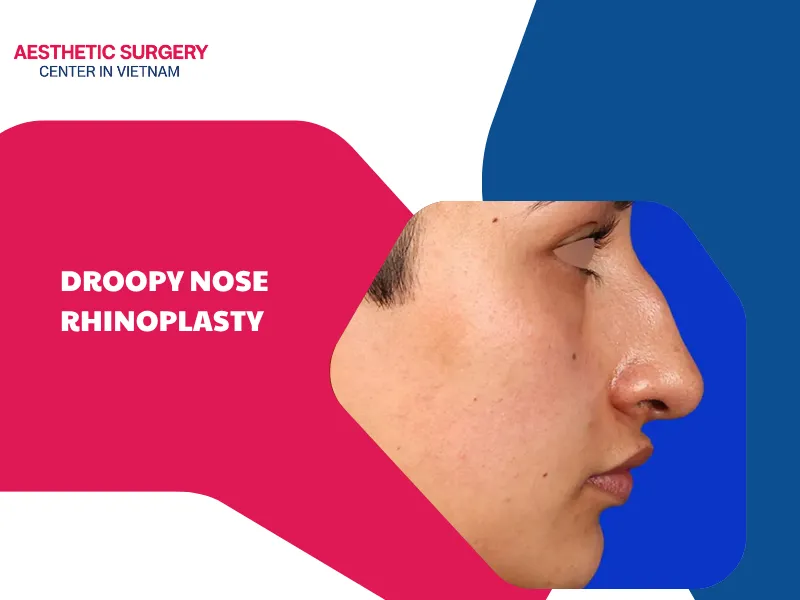What is droopy nose rhinoplasty? Benefits, risk and costs