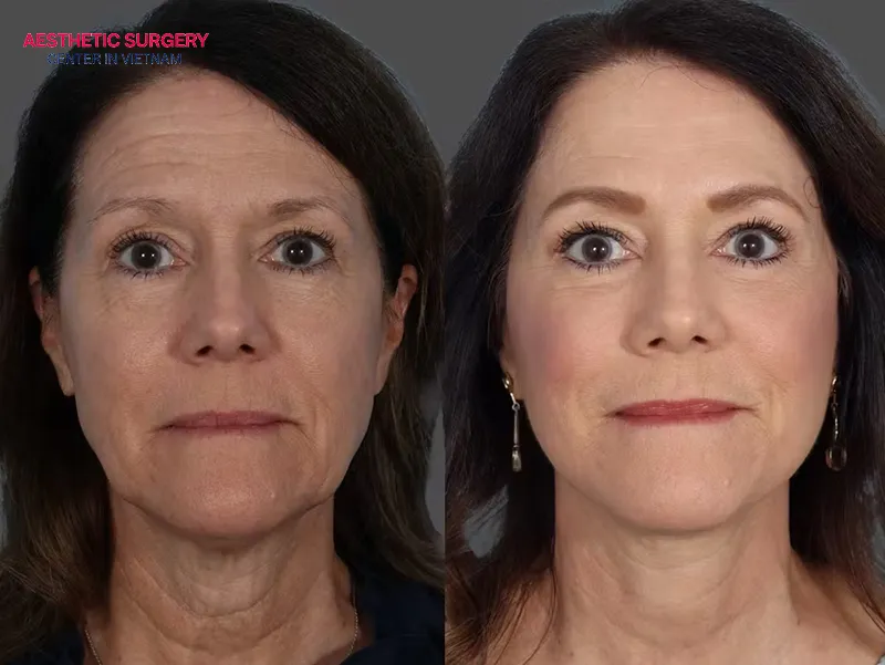 An endo brow lift delivers highly precise results.
