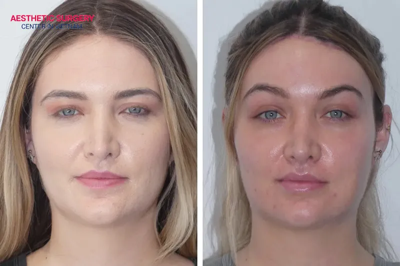 Endoscopic brow lift before and after 7 to 10 days.