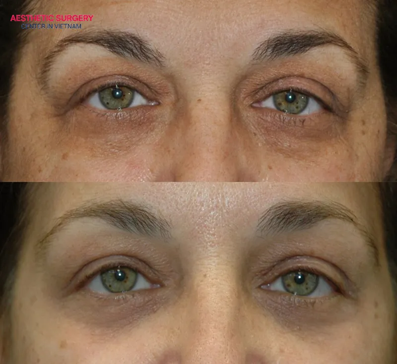 You should choose a reputable cosmetic clinic to minimize risks as much as possible.