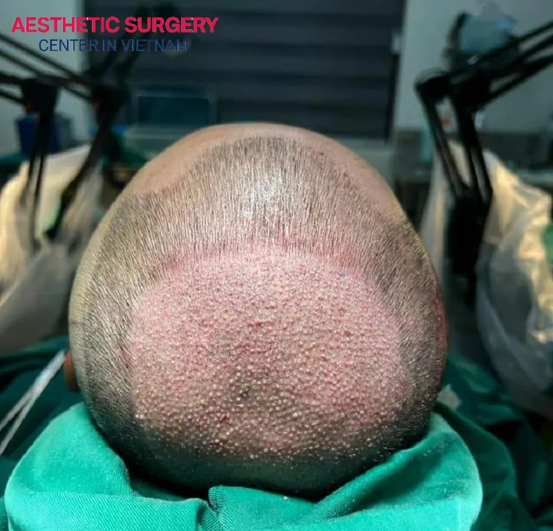 Engaging in physical activity too early post-hair transplant may lead to the loss or popping out of the grafts