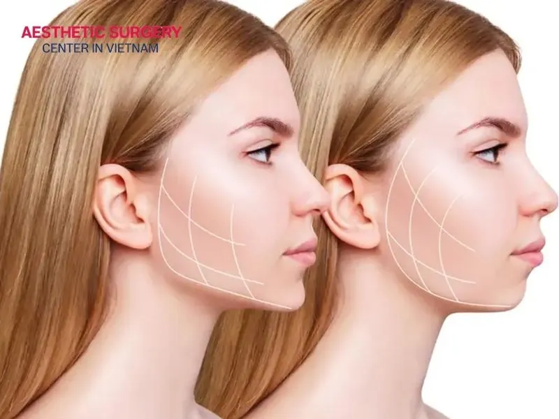Removing excess fat from the chin, cheeks, and neck makes the face look slimmer and more refined.