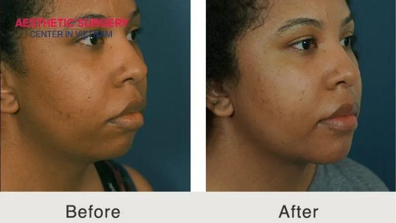 The chin and cheek areas show noticeable changes after liposuction face.