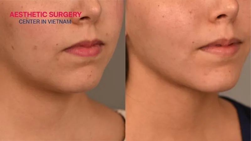 The face looks more youthful after facial liposuction.