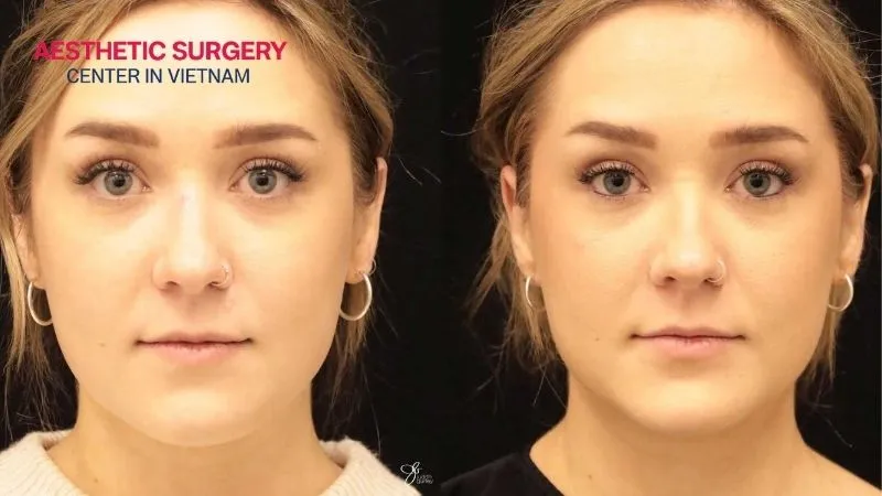 You can feel confident and refreshed immediately after facial liposuction.