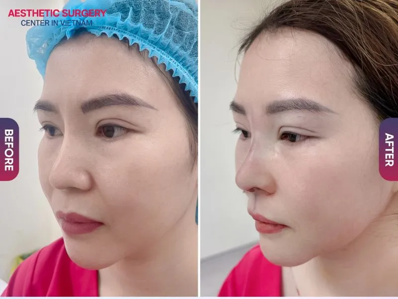 The nose has settled into a beautiful shape just one week following the procedure.