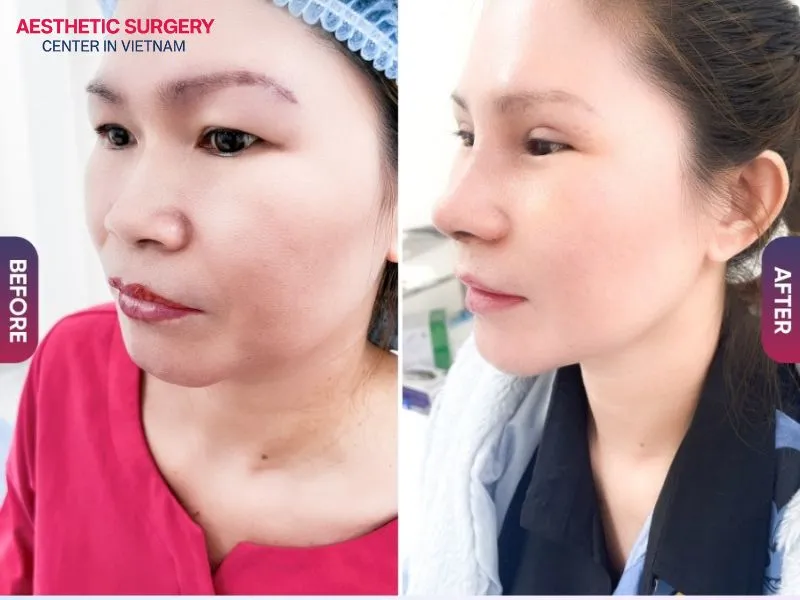 Correcting low nasal bridges and creating a balanced profile.