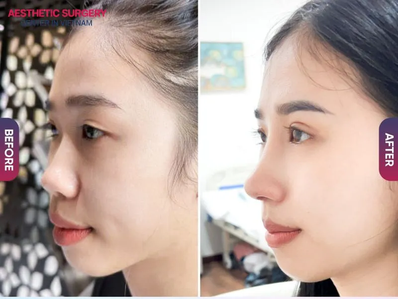 Correcting short noses to create a trendy 'flying' profile with Golden Ratio proportions