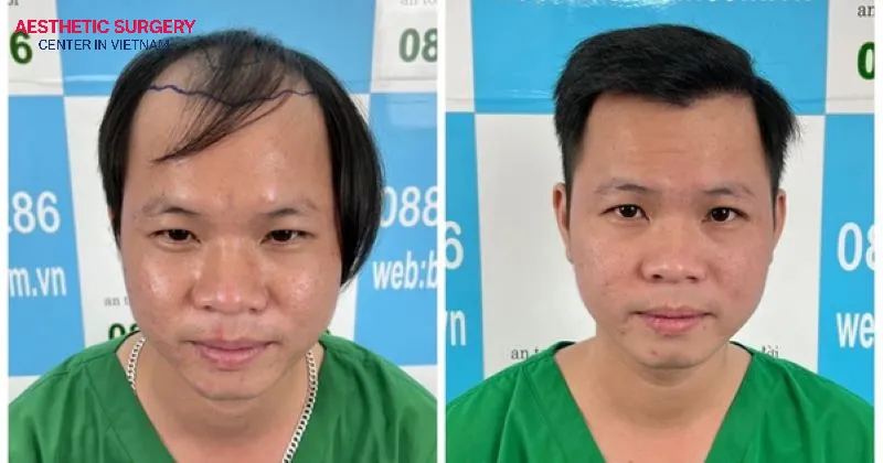 FUE hair transplant technology employs ultra-fine specialized tools to extract individual hair follicles directly from the donor site