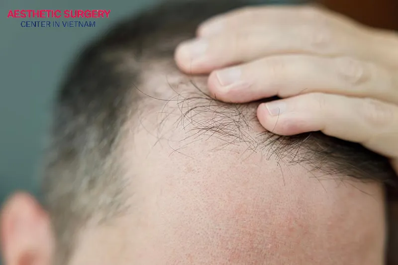 Individuals with moderate or localized hair loss, as shown in the image, may opt for hair transplantation using the Follicular Unit Extraction (FUE) method