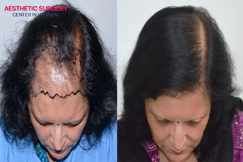 Following the 6 to 12-month post-transplant period, follicles achieve maximum length and resilience, enabling patients to perform regular grooming and styling