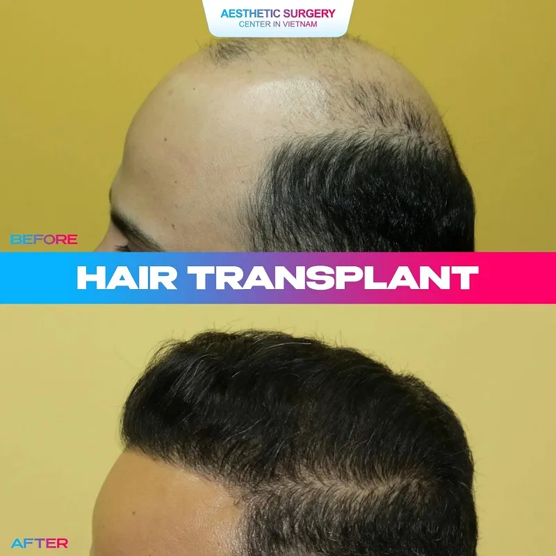 While the hair follicle regrowth rate can reach 90%, ensure you seek treatment at a high-quality facility