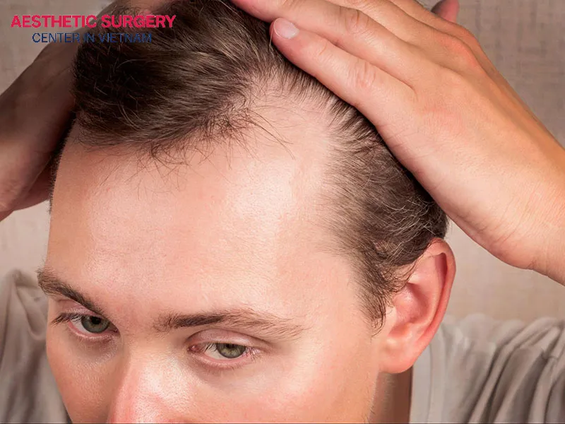 The causes of baldness are often genetic, hormonal imbalances, prolonged stress, and nutritional deficiencies