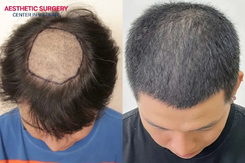 Hair transplantation completely resolves hair loss and thinning hair, restoring thick, full hair to clients