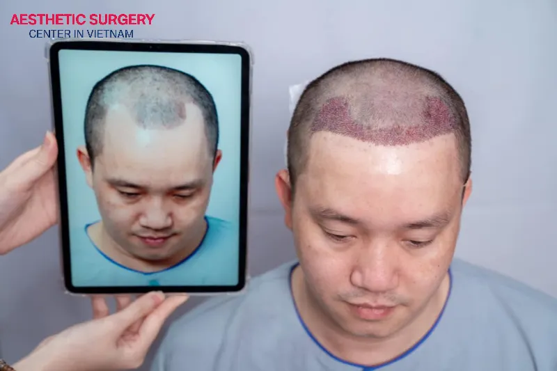 After a hair transplant, the hair will fully recover within 9-12 months