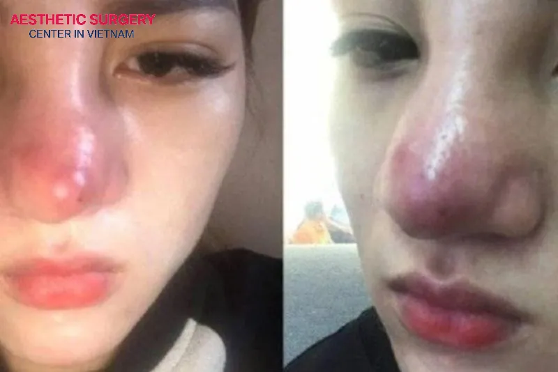 The nose may remain inflamed and swollen for longer if you start exercising too soon after