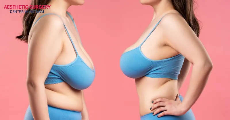 The cost of breast reduction surgery ranges from 15 to 100 million VND, depending on several factors