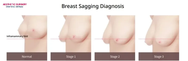 Each level of sagging will have a different cost.