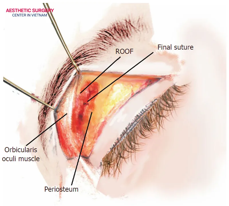 A limited incision brow lift is a minimally invasive cosmetic procedure.