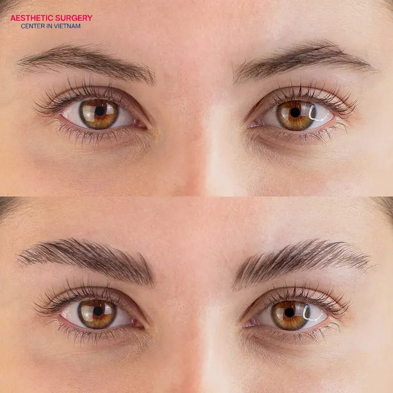 Mini brow lift results are natural, leave no visible scars, and allow for quick recovery.