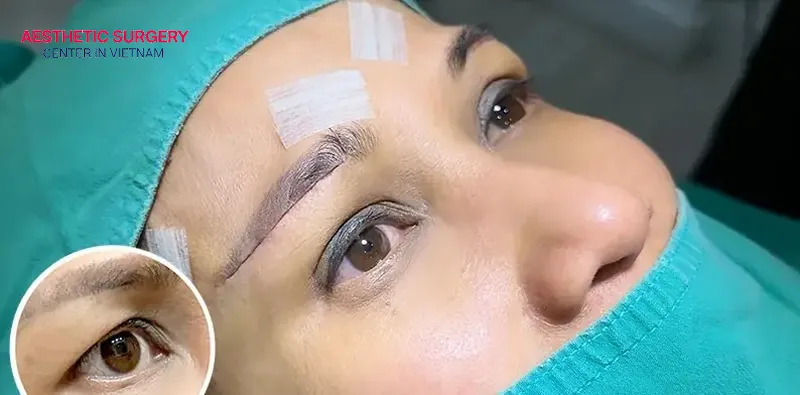 The limited incision brow lift procedure at aesthetic centers follows strict medical standards.