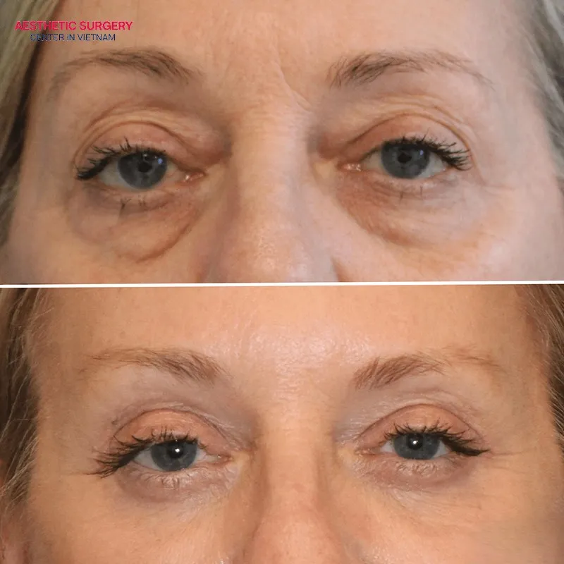 Completely corrects drooping eyelids and sagging eye corners