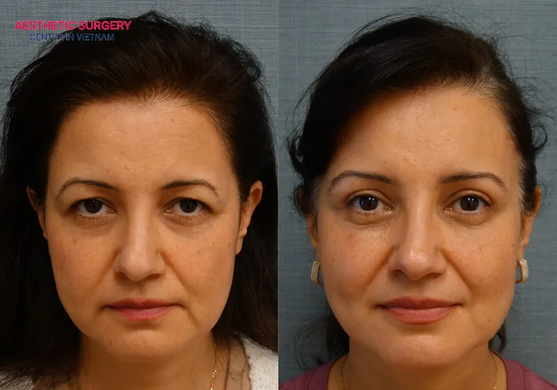 Fully improves drooping eyelids after a mini brow lift