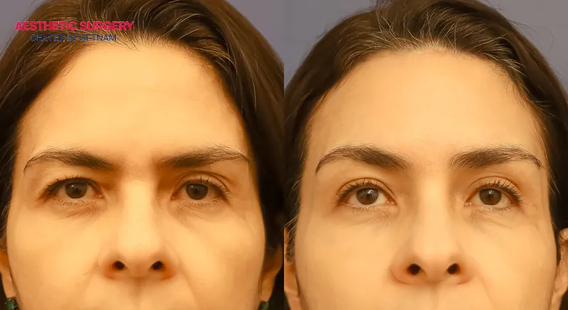 Deeper and more naturally rounded eyes after a mini brow lift