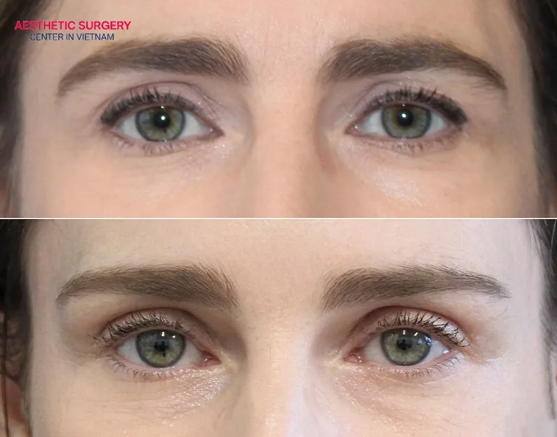 Balanced eyebrows and a more lively gaze