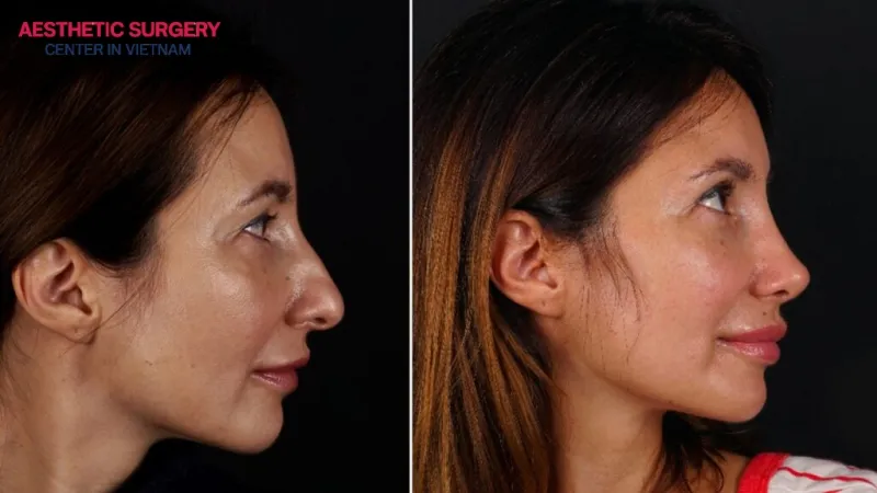 A fully developed facial structure is one of the key criteria for being suitable for button nose rhinoplasty.