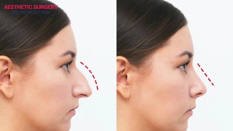 Button nose rhinoplasty is generally effective, but it still carries some risks.