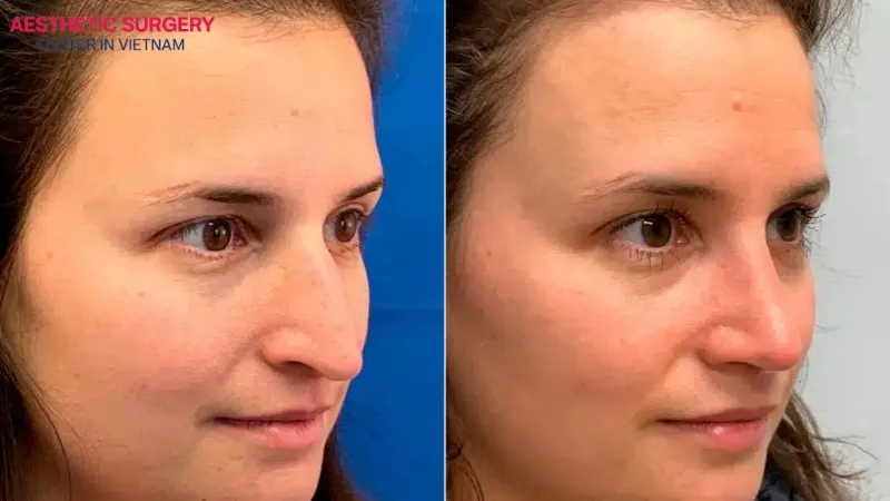Recovery and aftercare for button nose rhinoplasty