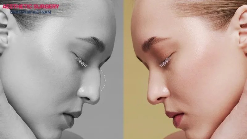 A rhinoplasty button nose creates a small, balanced nose with a soft and natural look.