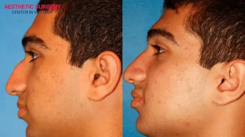Comparison between a droopy nose (left) and a normal nose (right)